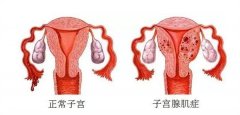 战胜子宫腺肌症梦魇，一场一连5年的保宫战，在北京卫人中医院宣告胜利